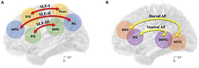Finding Cortical Subregions Regarding the Dorsal Language Pathway Based on the Structural Connectivity